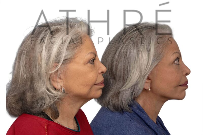 Revision facelift and facial rejuvenation surgery performed by Dr. Raghu Athré.