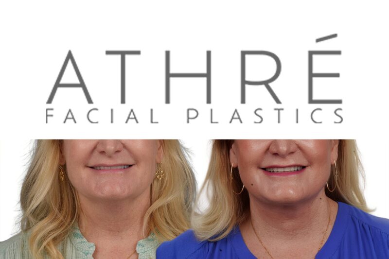Before and after deep plane facelift and chemical peel by Dr. Raghu Athré in female patient.