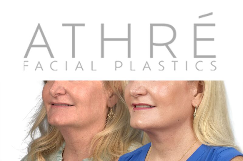 Female patient after 4D Facelift™, deep neck lift, and facial fat transfer by Dr. Raghu Athré.