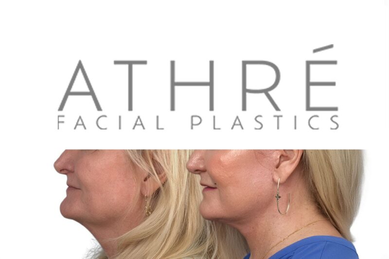 Before and after facial rejuvenation with facelift and stem cell nanofat treatment by Dr. Raghu Athré.
