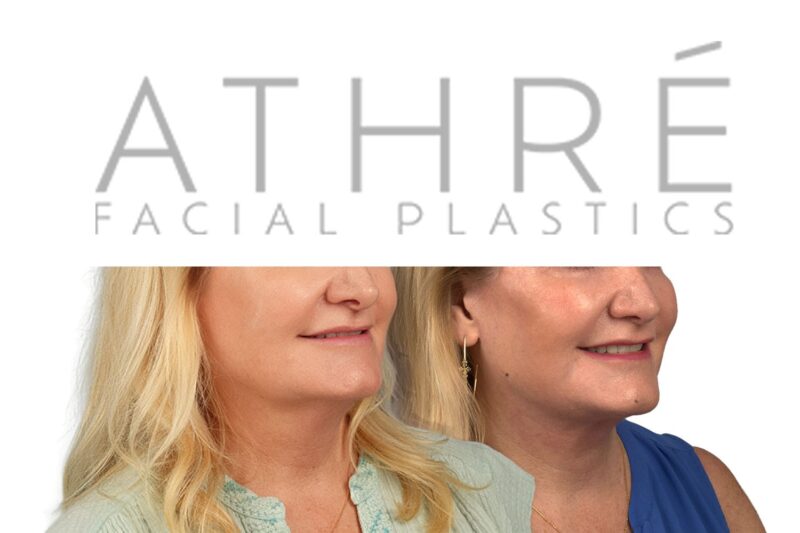 Female patient shown after full-face chemical peel and neck lift performed by Dr. Raghu Athré.