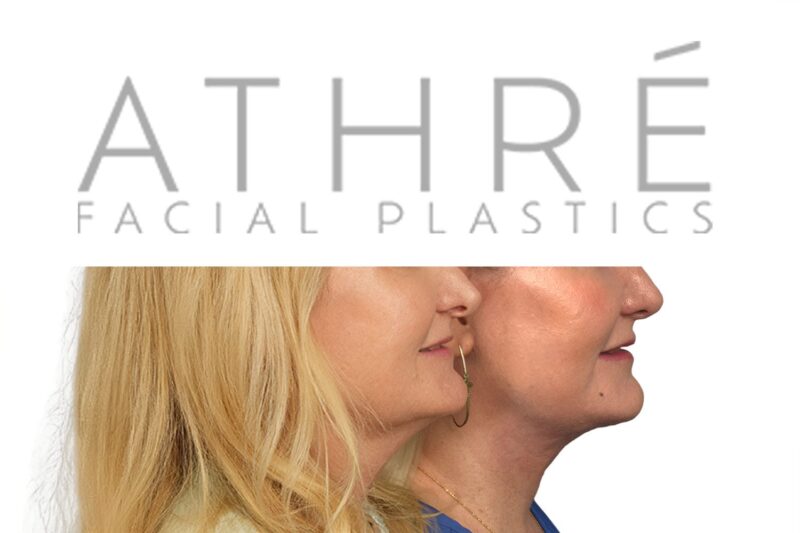 Facial rejuvenation surgery including facelift and facial resurfacing by Dr. Raghu Athré.