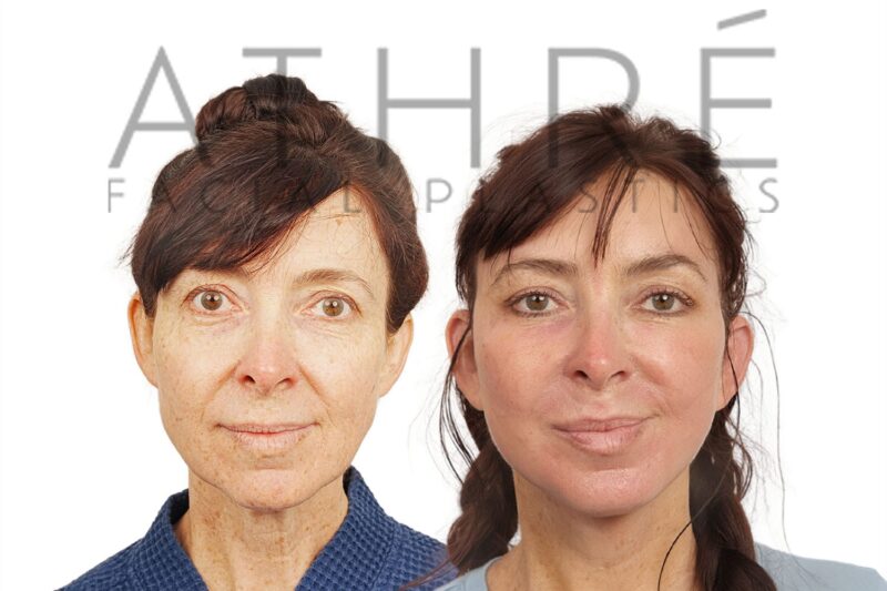 Before and after deep plane facelift, brow lift, and neck lift by Dr. Raghu Athré in 55-year-old female patient.
