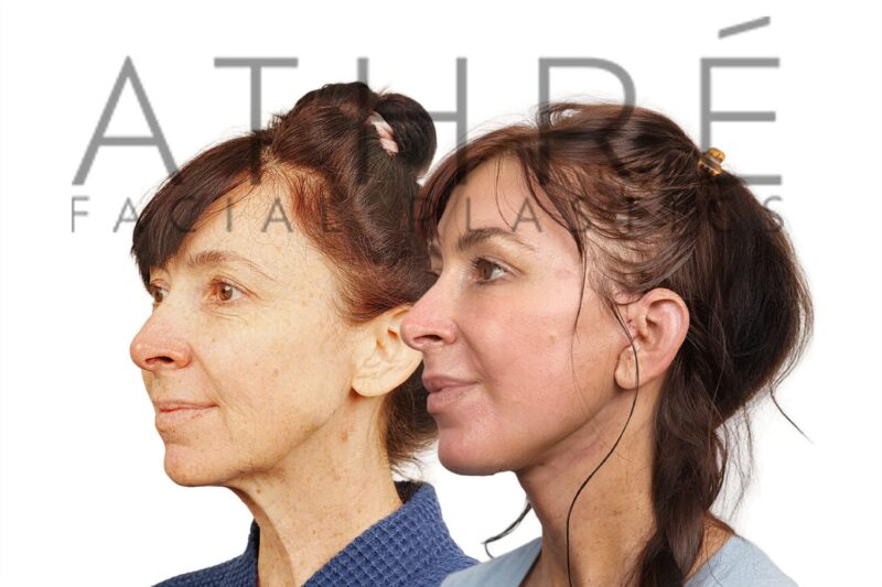 Female patient after 4D Facelift™, facial fat transfer, and chemical peel by Dr. Raghu Athré.