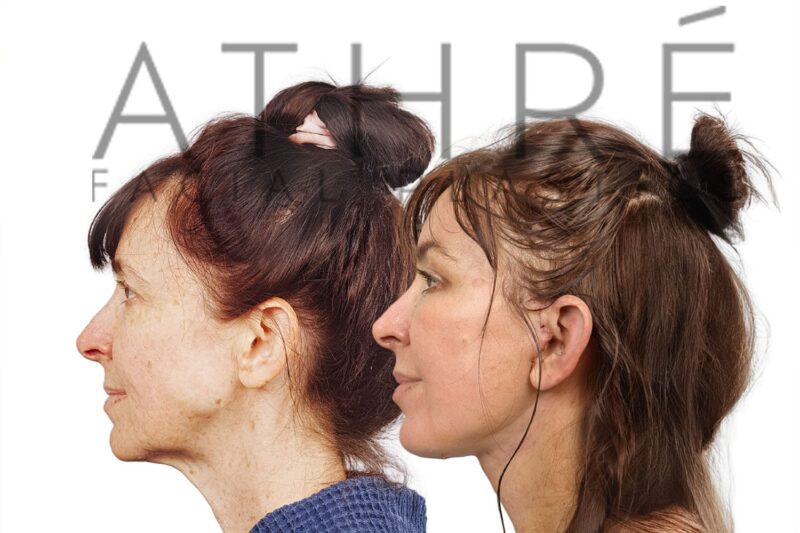 Before and after facial rejuvenation with facelift and stem cell nanofat treatment by Dr. Raghu Athré.