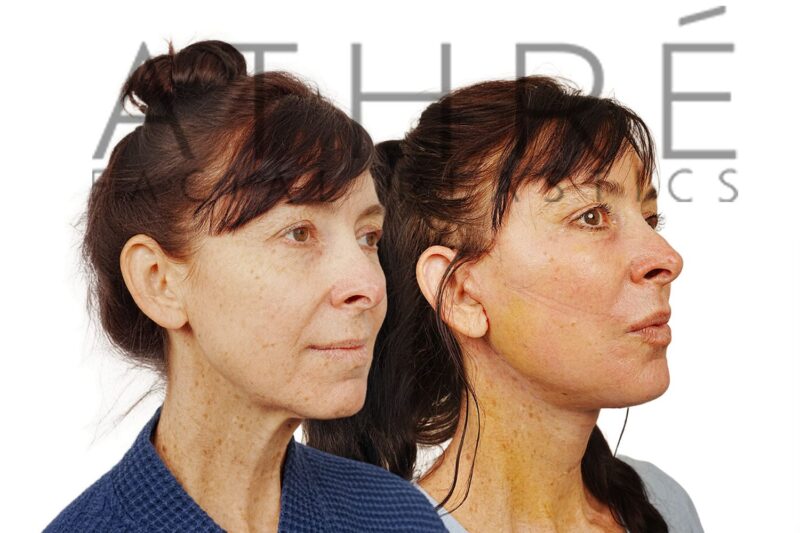 55-year-old woman shown after brow lift and facial resurfacing performed by Dr. Raghu Athré.