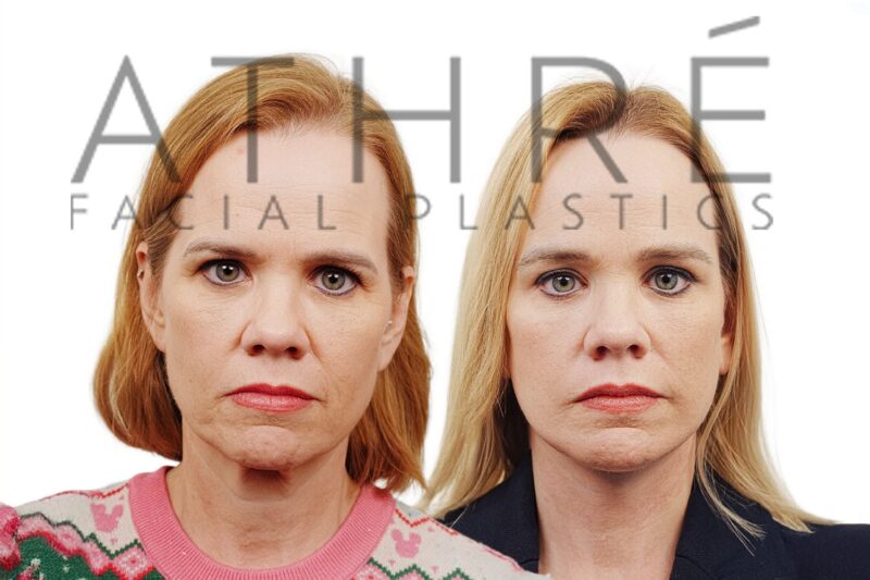 Before and after deep plane facelift and chemical peel by Dr. Raghu Athré in 52-year-old female patient.