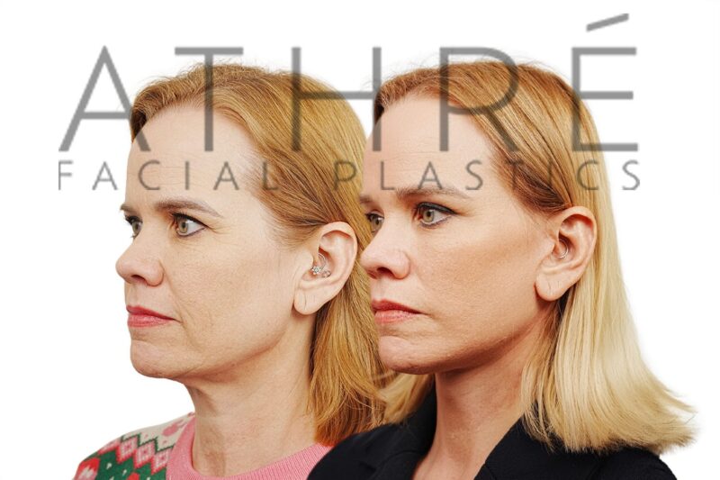Female patient after 4D Facelift™, deep neck lift, and facial fat transfer by Dr. Raghu Athré.