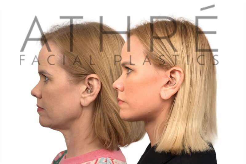 Before and after facial rejuvenation with facelift and stem cell nanofat treatment by Dr. Raghu Athré.