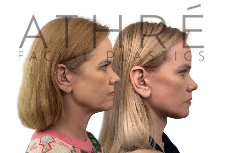Facial rejuvenation surgery including facelift and facial resurfacing by Dr. Raghu Athré.