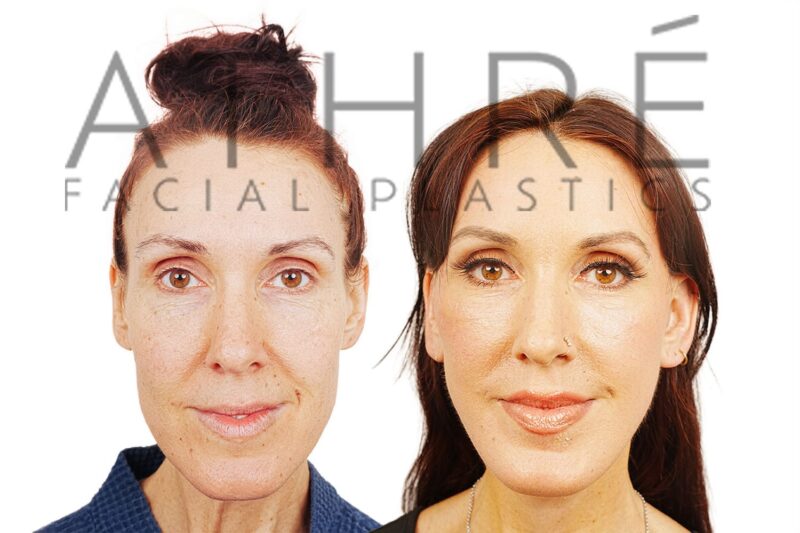 Before and after deep plane facelift and chemical peel by Dr. Raghu Athré in 49-year-old female patient.