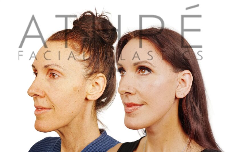 Female patient after 4D Facelift™, deep neck lift, facial fat transfer, and lip augmentation by Dr. Raghu Athré.