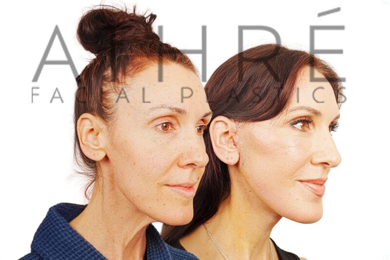 Before and after facial rejuvenation with facelift and stem cell nanofat treatment by Dr. Raghu Athré.