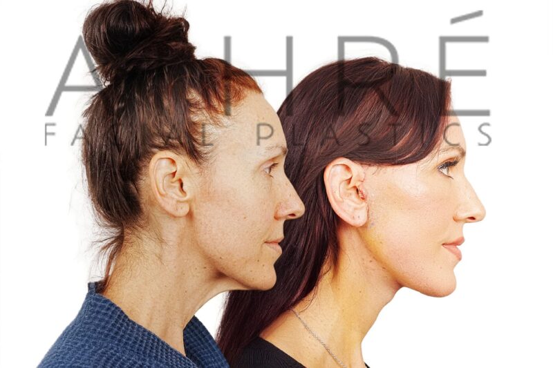 Side-by-side profile photos of a woman before and after a facelift