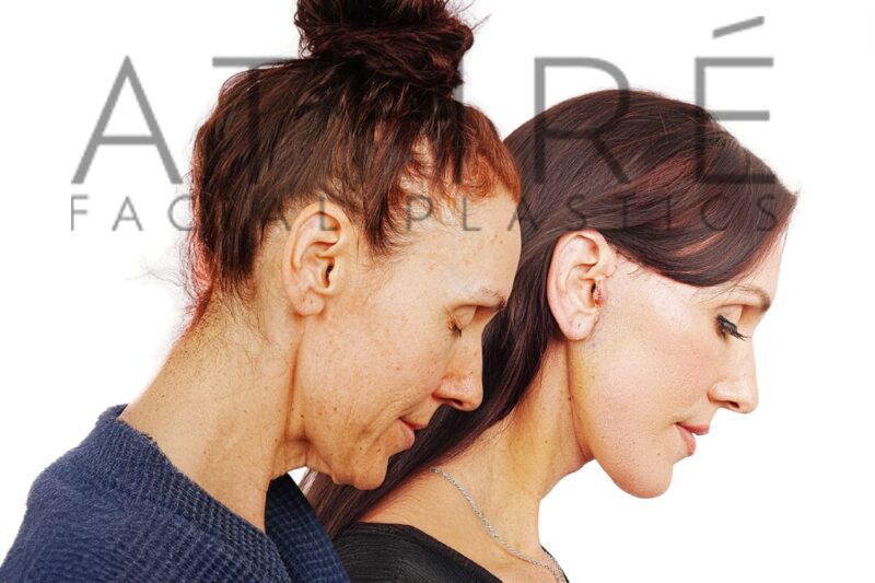 49-year-old woman shown after full-face chemical peel and neck lift performed by Dr. Raghu Athré.