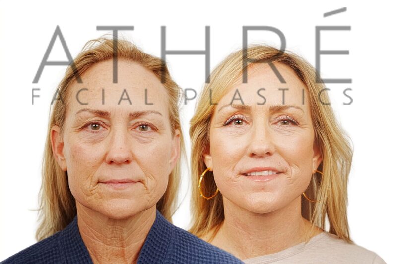 Before and after deep plane facelift, brow lift, and blepharoplasty by Dr. Raghu Athré in 57-year-old female patient.