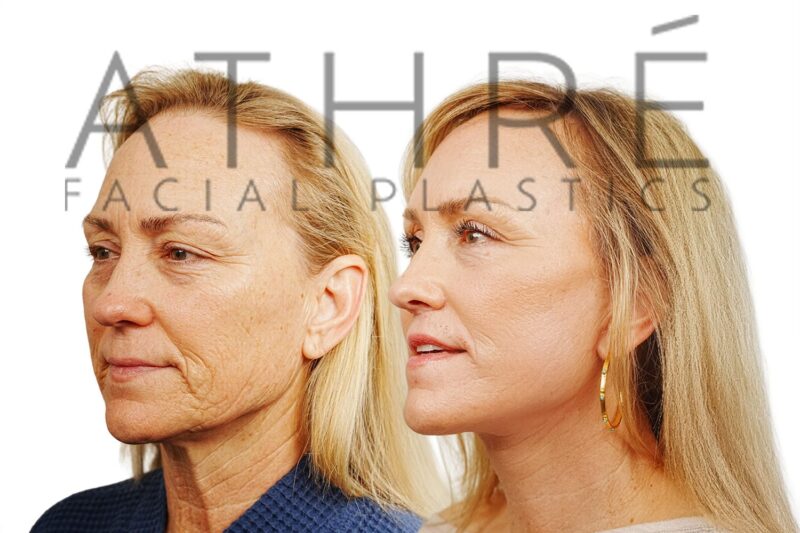 Female patient after 4D Facelift™, facial fat transfer, lip lift procedures, and neck lift by Dr. Raghu Athré.