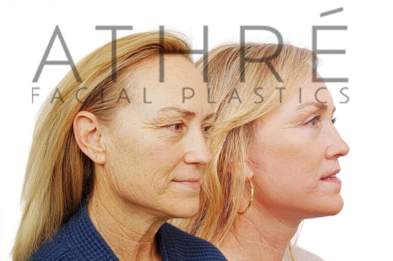 Before and after facial rejuvenation with facelift and full-face chemical peel by Dr. Raghu Athré.
