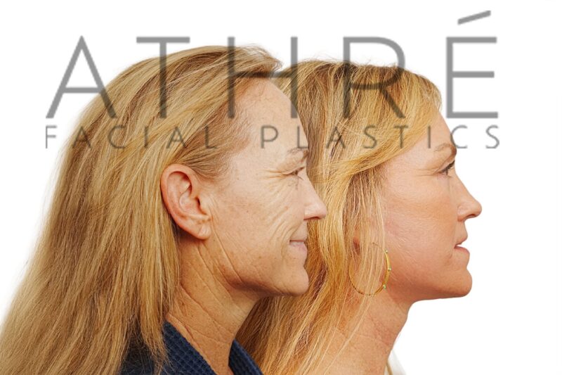 57-year-old woman shown after upper and lower eyelid surgery and stem cell nanofat treatment performed by Dr. Raghu Athré.