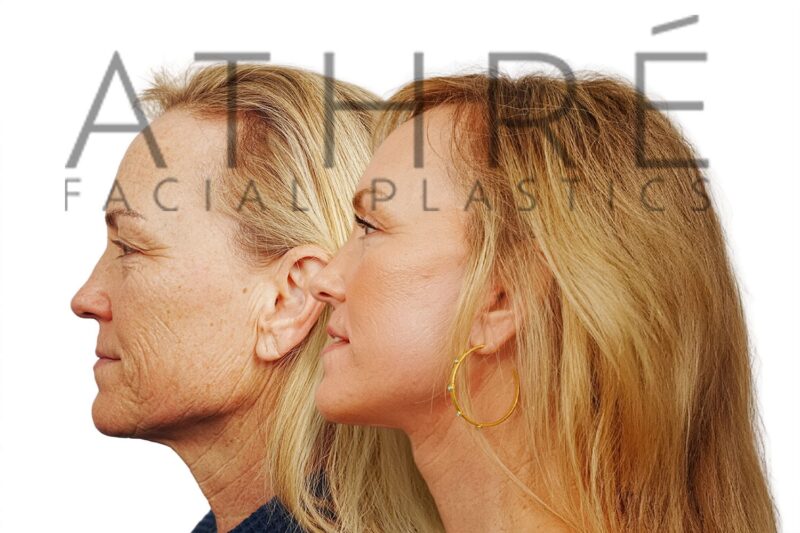 Facial rejuvenation surgery including facelift, lip lifts, and brow lift performed by Dr. Raghu Athré.