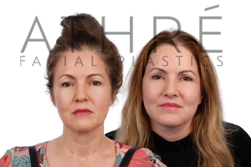 Before and after revision deep plane facelift and upper blepharoplasty by Dr. Raghu Athré in 58-year-old female patient.
