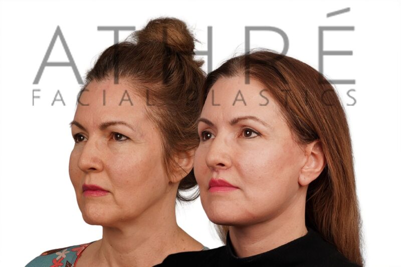 Female patient after revision 4D Facelift™, facial fat transfer, lip lifts, and neck lift by Dr. Raghu Athré.
