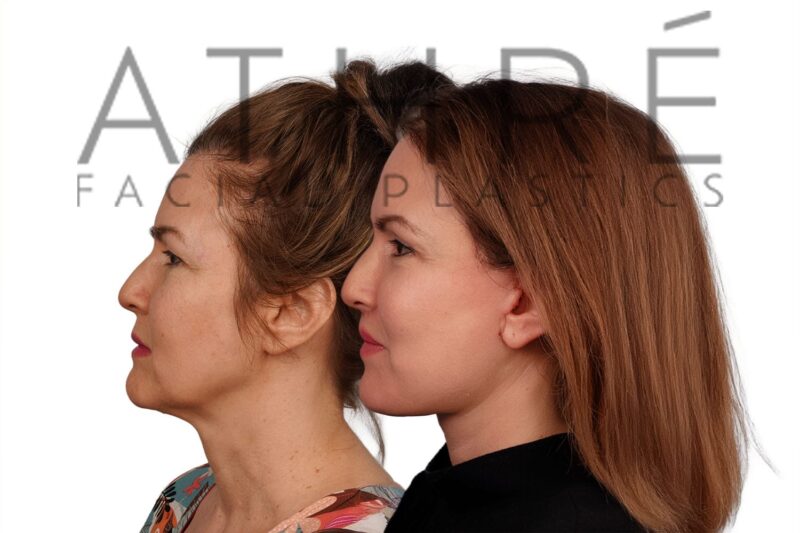 Before and after facial rejuvenation with revision facelift and chemical peel by Dr. Raghu Athré.