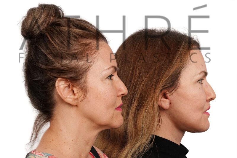 Revision facelift and facial rejuvenation surgery performed by Dr. Raghu Athré.