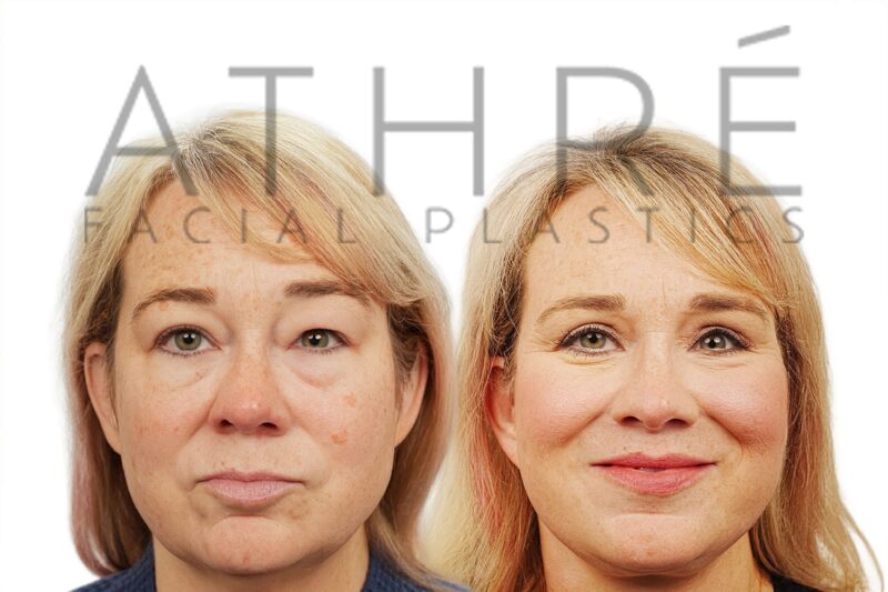 Before and after deep plane facelift and upper eyelid surgery by Dr. Raghu Athré in female patient.
