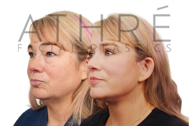 Female patient after 4D Facelift™, deep neck lift, and facial fat transfer by Dr. Raghu Athré.