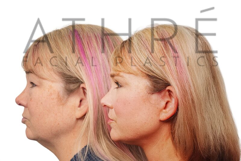 Before and after facial rejuvenation with facelift and revision ptosis repair by Dr. Raghu Athré.