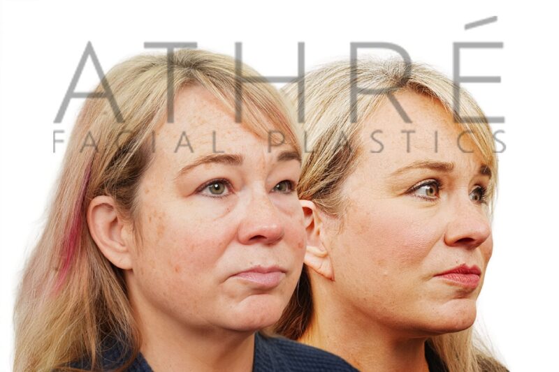 Female patient shown after lip augmentation and stem cell nanofat treatment performed by Dr. Raghu Athré.
