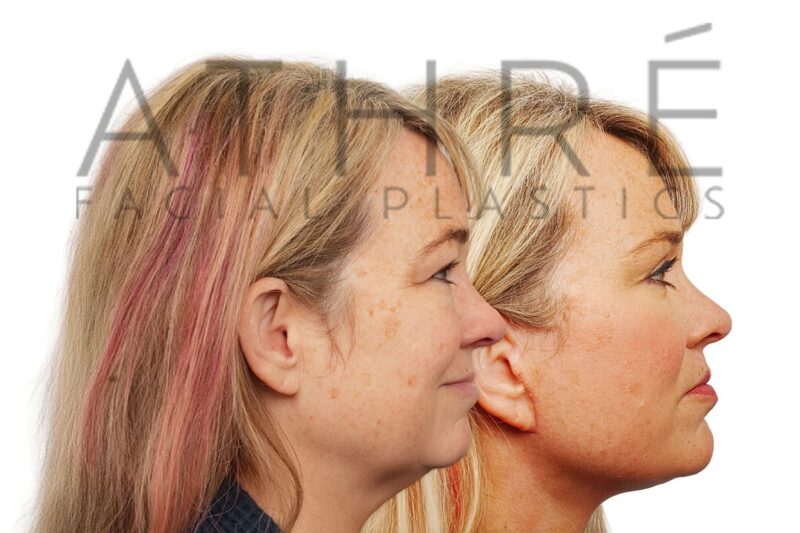 Facial rejuvenation surgery including facelift and corrective blepharoplasty performed by Dr. Raghu Athré.
