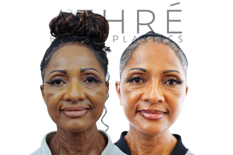 Before and after deep plane facelift and neck lift by Dr. Raghu Athré in 63-year-old female patient.