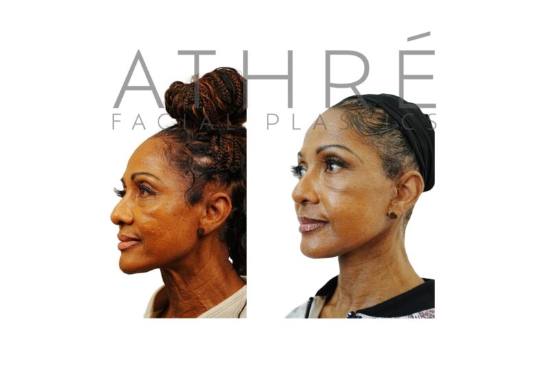 Female patient after 4D Facelift™, facial fat transfer, and stem cell nanofat treatment by Dr. Raghu Athré.