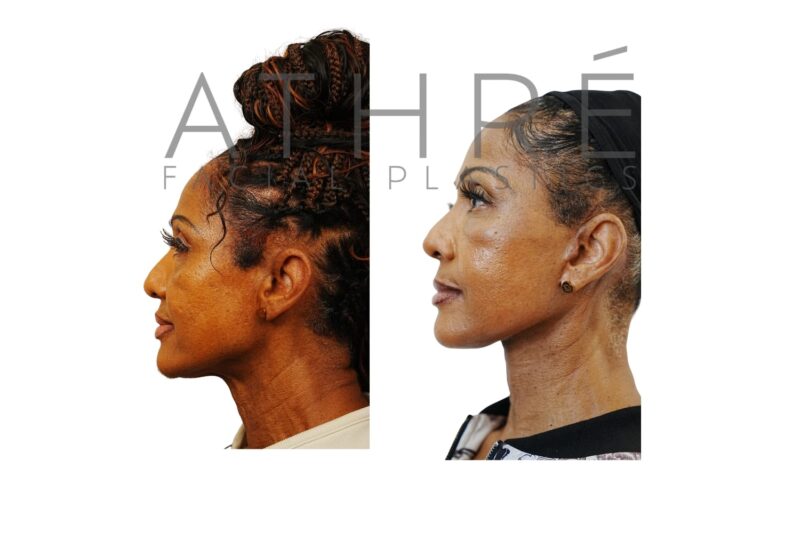 Before and after facial rejuvenation with deep plane facelift by Dr. Raghu Athré.