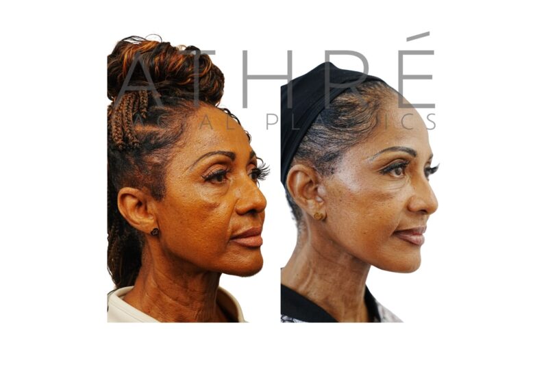 63-year-old woman shown after deep neck lift and facial fat grafting performed by Dr. Raghu Athré.