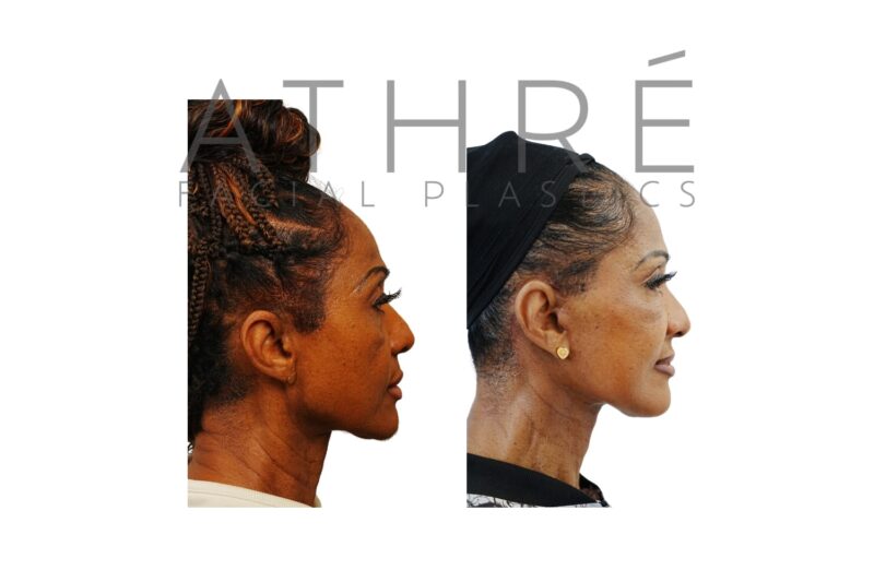 Before and after 4D Facelift™, deep neck lift, and facial fat transfer by Dr. Raghu Athré in 63-year-old female patient.