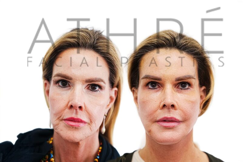 Before and after revision deep plane facelift and brow lift by Dr. Raghu Athré in 57-year-old female patient.