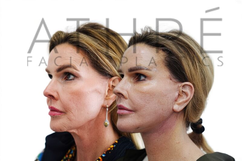 Female patient after revision 4D Facelift™, deep neck lift, and facial fat transfer by Dr. Raghu Athré.