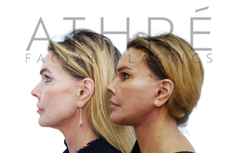 Before and after facial rejuvenation with revision facelift and cheek implant removal by Dr. Raghu Athré.