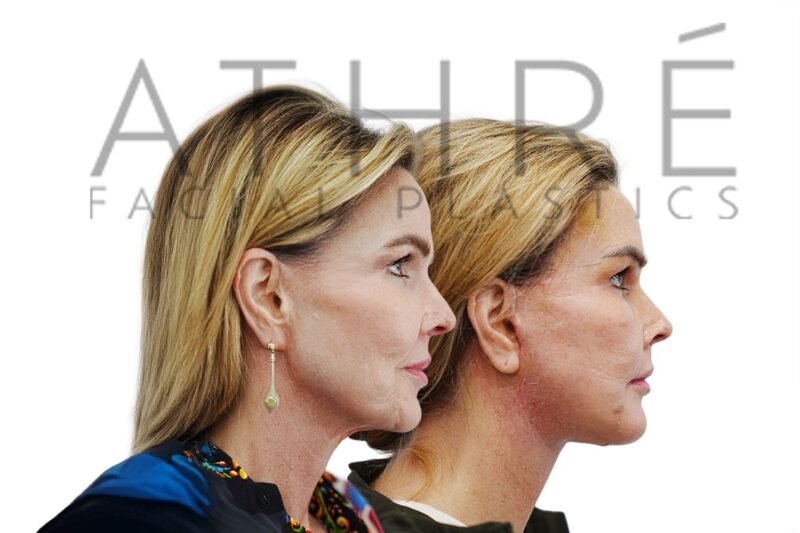 57-year-old woman shown after brow lift and stem cell nanofat treatment performed by Dr. Raghu Athré.