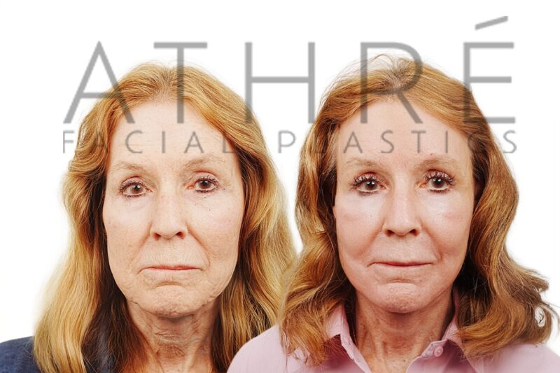 Before and after revision deep plane facelift and brow lift by Dr. Raghu Athré in 75-year-old female patient.