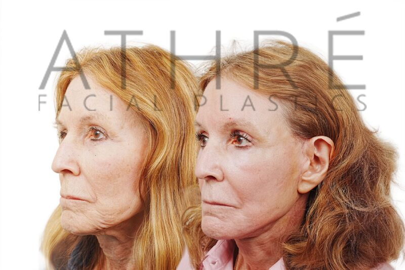 Female patient after revision 4D Facelift™, deep neck lift, and facial fat transfer by Dr. Raghu Athré.