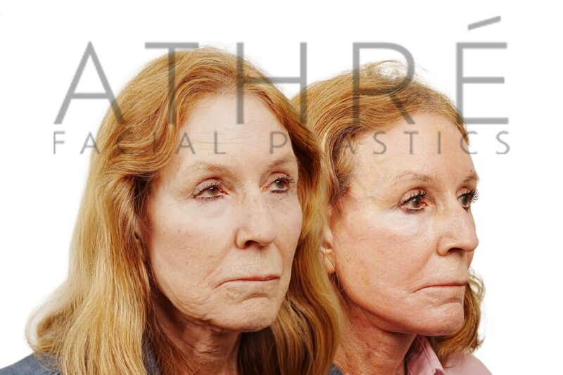 75-year-old woman shown after brow lift and stem cell nanofat treatment performed by Dr. Raghu Athré.