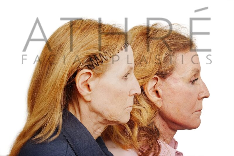 Revision facelift and facial rejuvenation surgery performed by Dr. Raghu Athré.