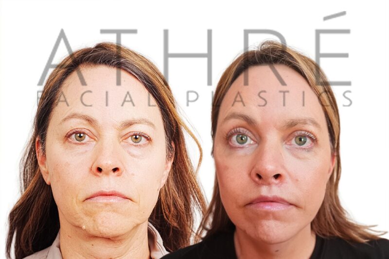 Before and after deep plane facelift and blepharoplasty by Dr. Raghu Athré in 53-year-old female patient.