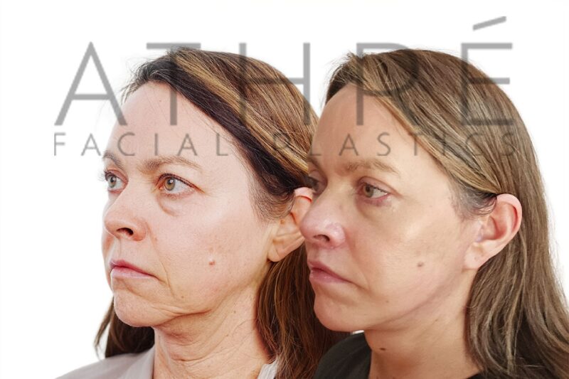 Female patient after 4D Facelift™, deep neck lift, and facial fat transfer by Dr. Raghu Athré.