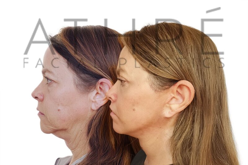 Before and after facial rejuvenation with facelift and lip lift by Dr. Raghu Athré.