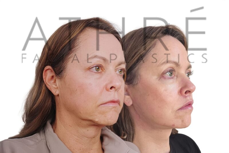53-year-old woman shown after upper and lower eyelid surgery and stem cell nanofat treatment performed by Dr. Raghu Athré.